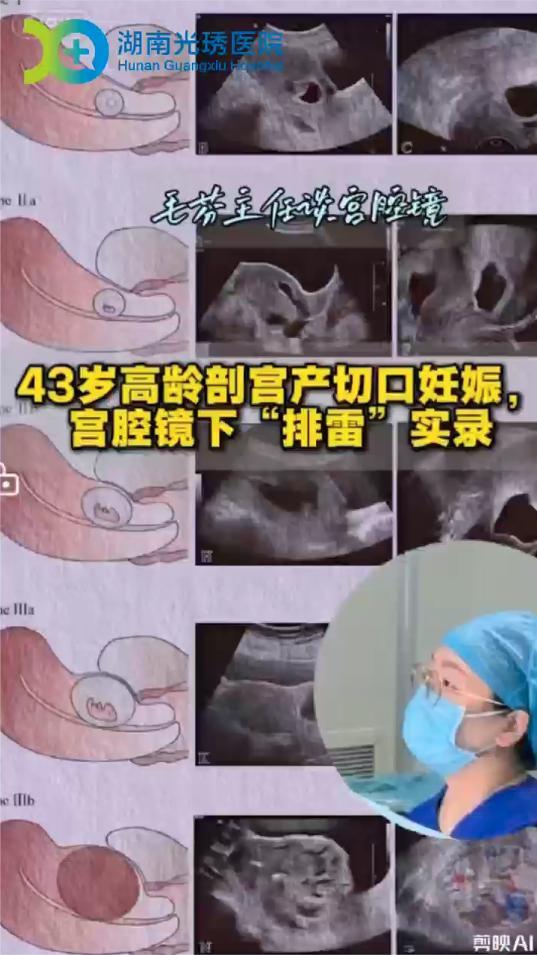 43岁高龄孕妇遇剖宫产切口妊娠，宫腔镜下“排雷”助她化险为夷