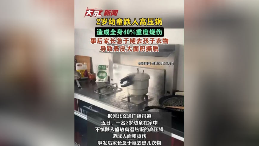 2岁幼童跌入高压锅，造成全身40%重度烧伤，事后家长急于褪去孩子衣物，导致表皮大面积撕脱