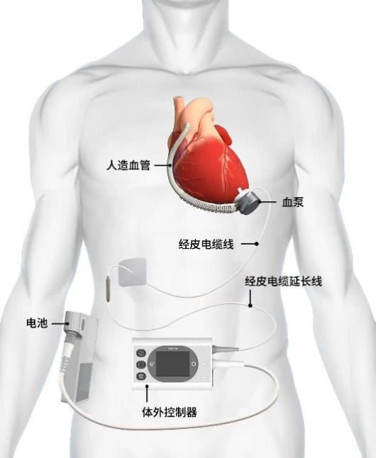 同心医疗BrioVAD在德国完成首例植入,全球临床验证持续提速 同心医疗BrioVAD在德国完成首例植入,全球临床验证持续提速