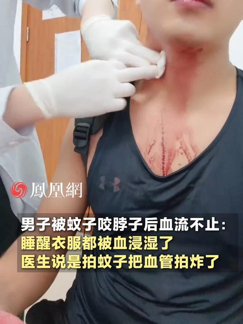 男子被蚊子咬脖子后血流不止：睡醒衣服都被血浸湿了，医生说是拍蚊子把血管拍炸了（素材来源：@阿瑞斯 ）#上海 #夏天 #社会