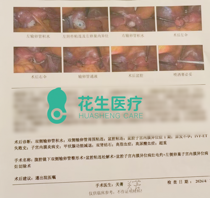 智塑未来, 花生腔镜专家关菁：输卵管积水勿盲目试管，先拆“炸弹”