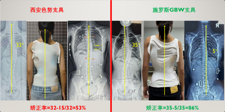 数字化与生物力学双重跃迁：施罗斯GBW支具何以引领脊柱侧弯保守治疗跨代变革