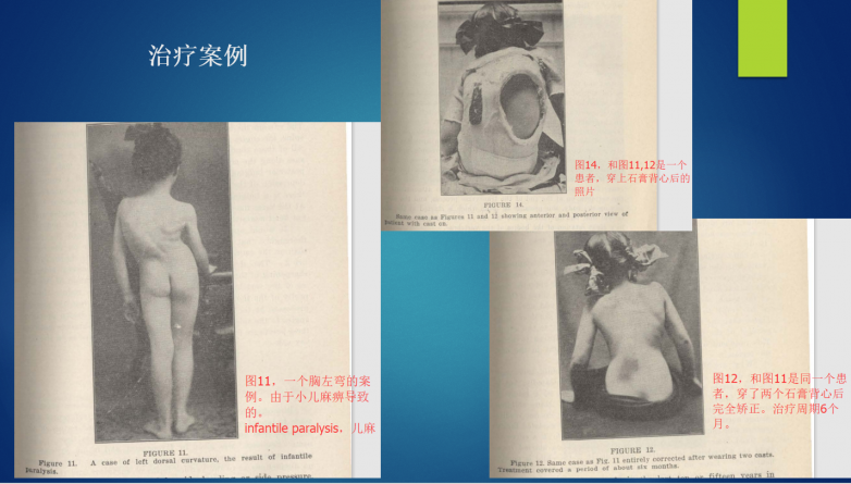 数字化与生物力学双重跃迁：施罗斯GBW支具何以引领脊柱侧弯保守治疗跨代变革