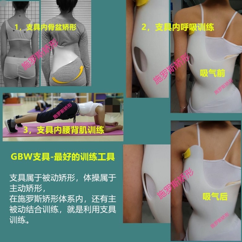 数字化与生物力学双重跃迁：施罗斯GBW支具何以引领脊柱侧弯保守治疗跨代变革