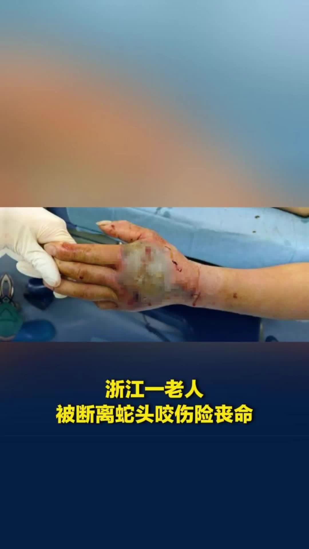 大爷砍死毒蛇，5分钟后蛇头突然“复仇”！被咬不到20分钟手臂肿成茄子，生命垂危