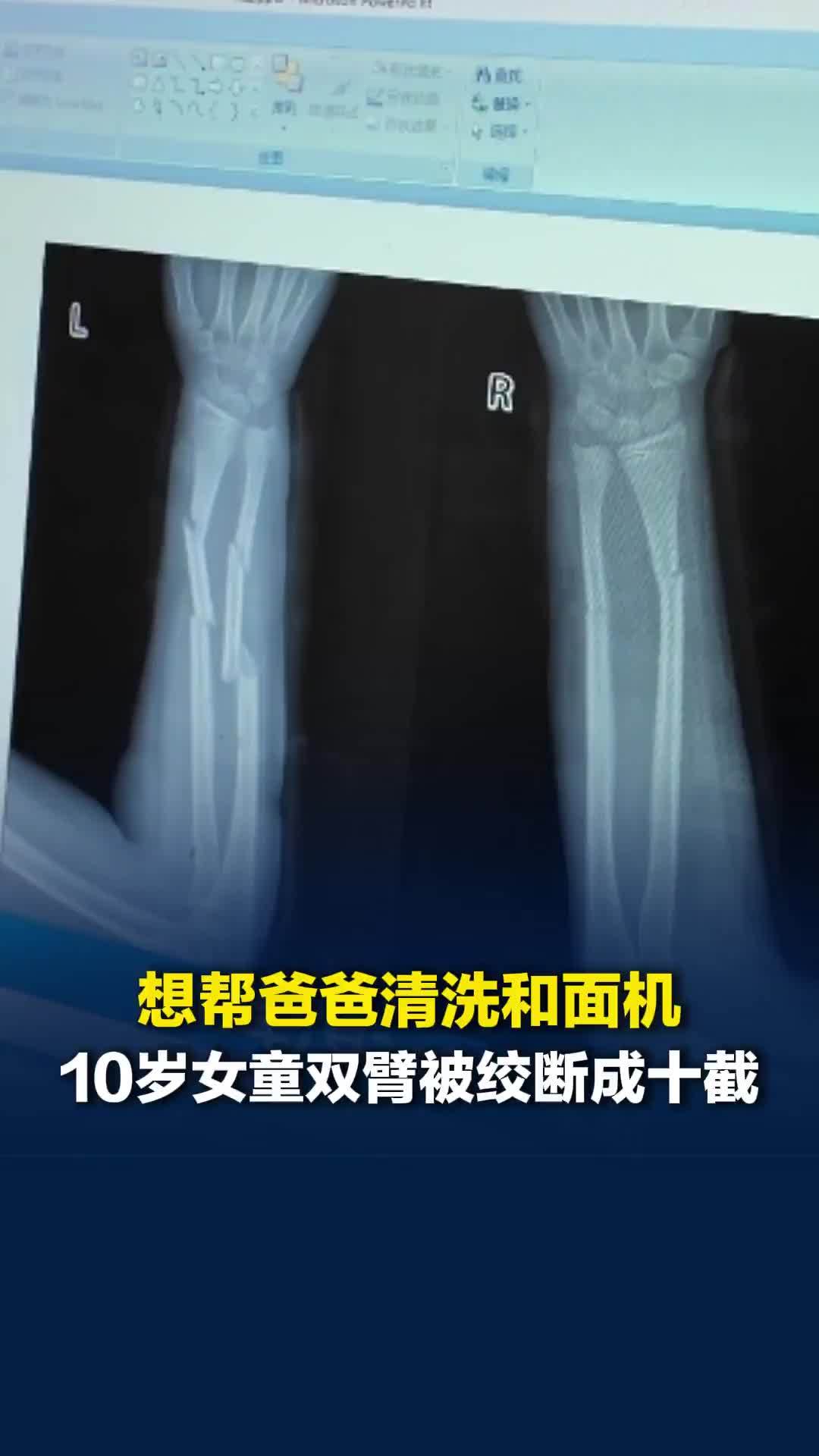 想帮爸爸清洗和面机，10岁女童双臂被绞断成十截！3次手术后痊愈写下“我要出院了”