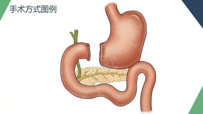 毕II式图片