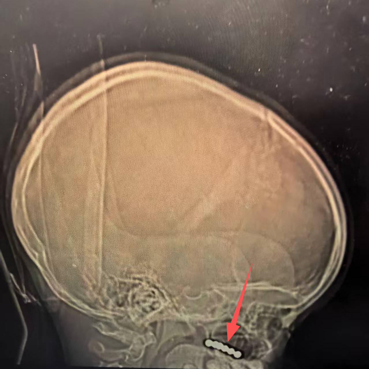 CT发现的磁力珠