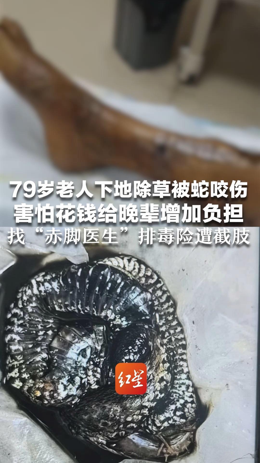 79岁老人下地除草被蛇咬伤 害怕花钱给晚辈增加负担 找“赤脚医生”处理险遭截肢 后及时转院挽回一命