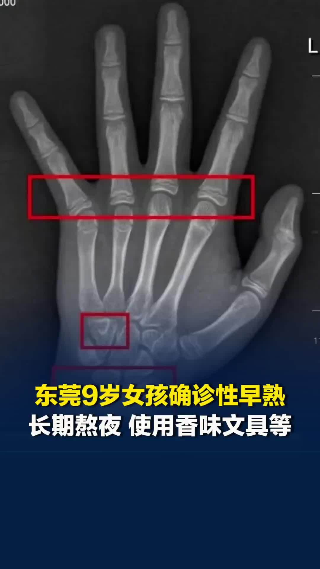 东莞一9岁女孩确诊性早熟，骨龄达12岁，长期高碳水饮食、熬夜、使用香味文具等