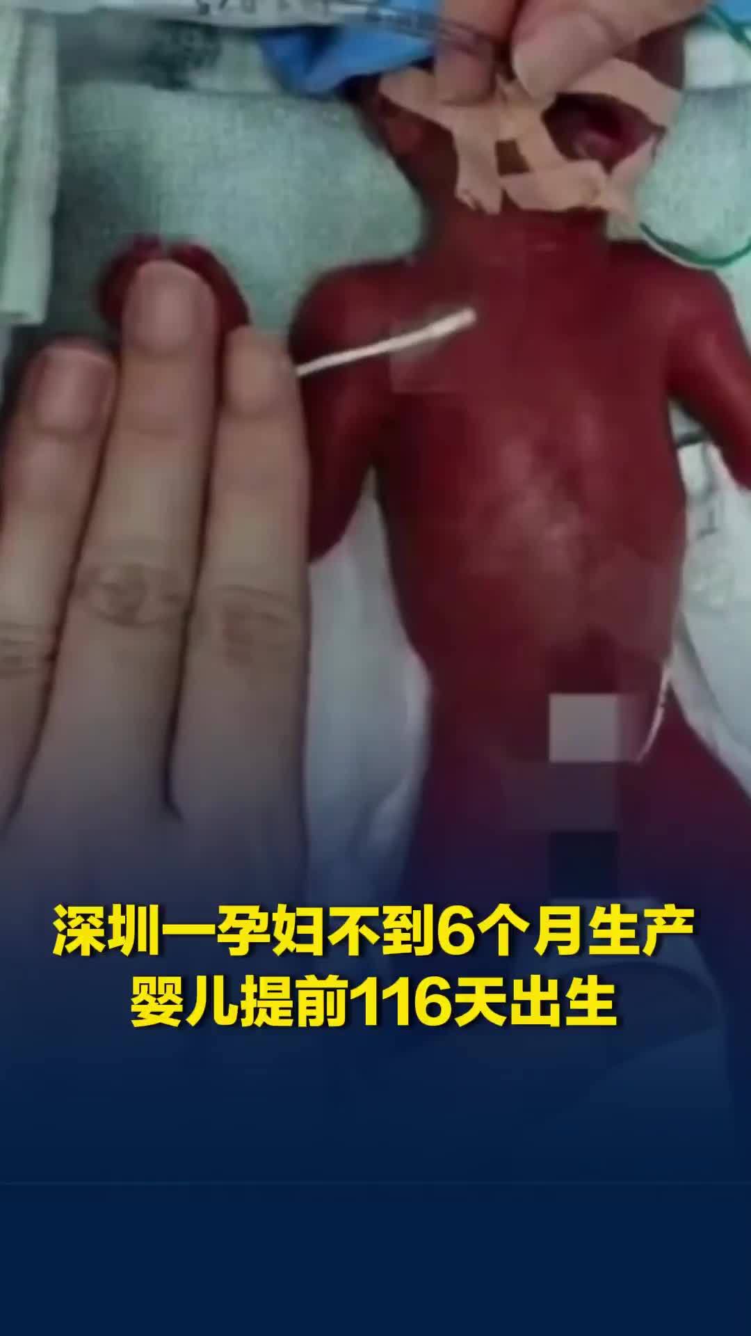 仅330克！深圳一名孕妇不到6个月产下巴掌大宝宝，经过105天救治平安出院