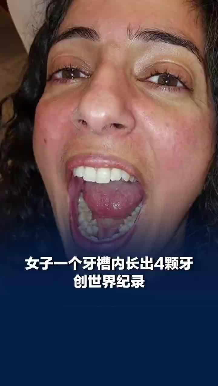 一个牙槽内长出4颗牙创世界纪录，女子一个牙槽内长出4颗牙
