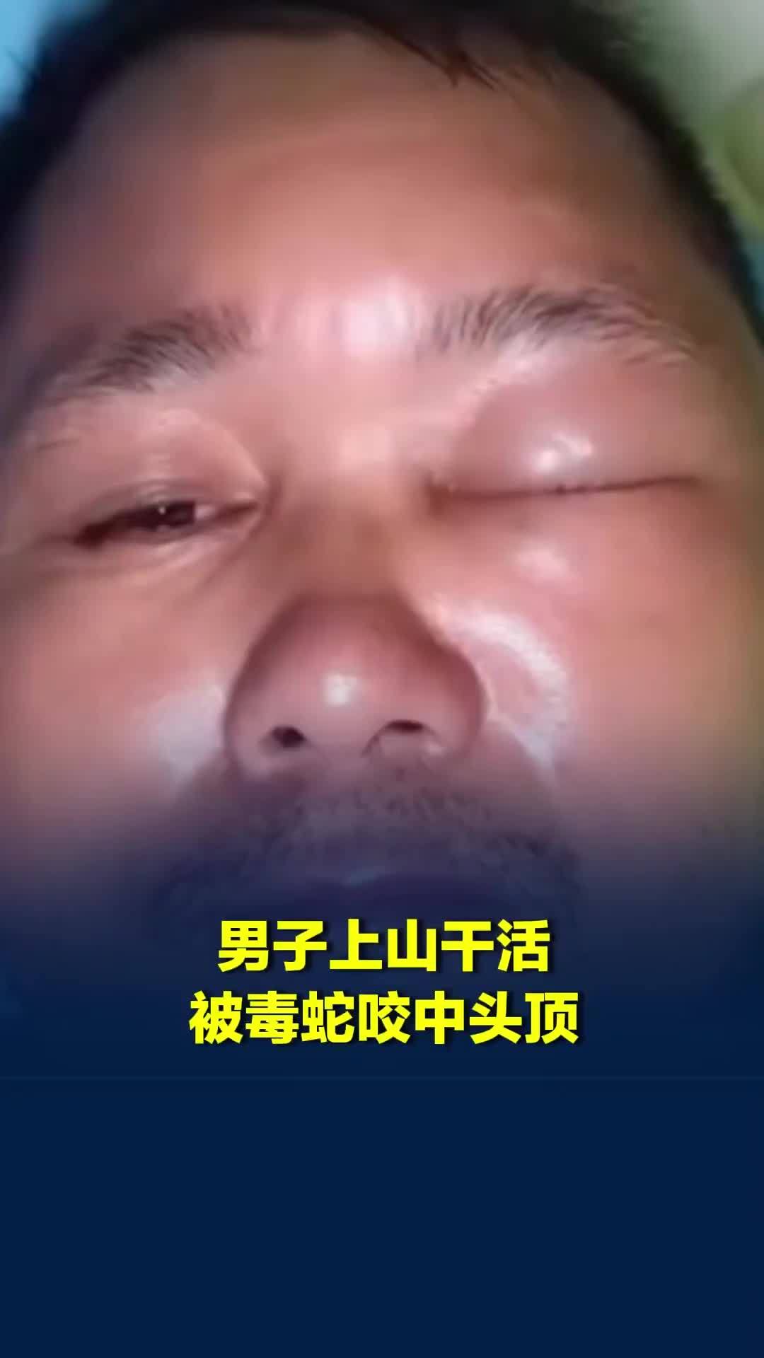 男子上山干活被树上的毒蛇咬中头顶，当事人：半边头肿胀，已去医院打血清