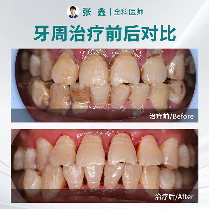 义乌傅氏口腔牙周治疗案例