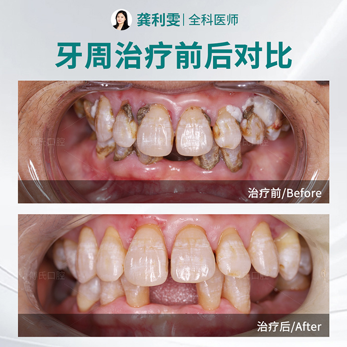 义乌傅氏口腔牙周治疗案例