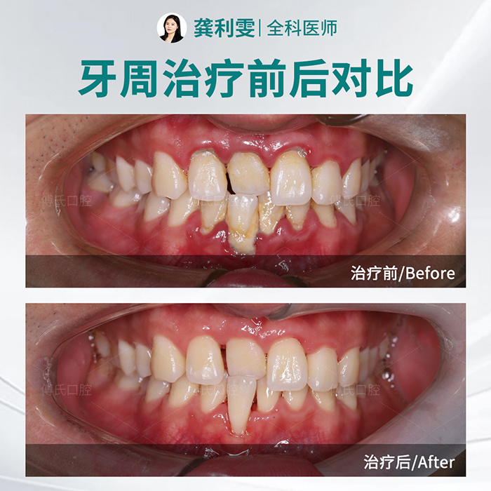 义乌傅氏口腔牙周治疗案例