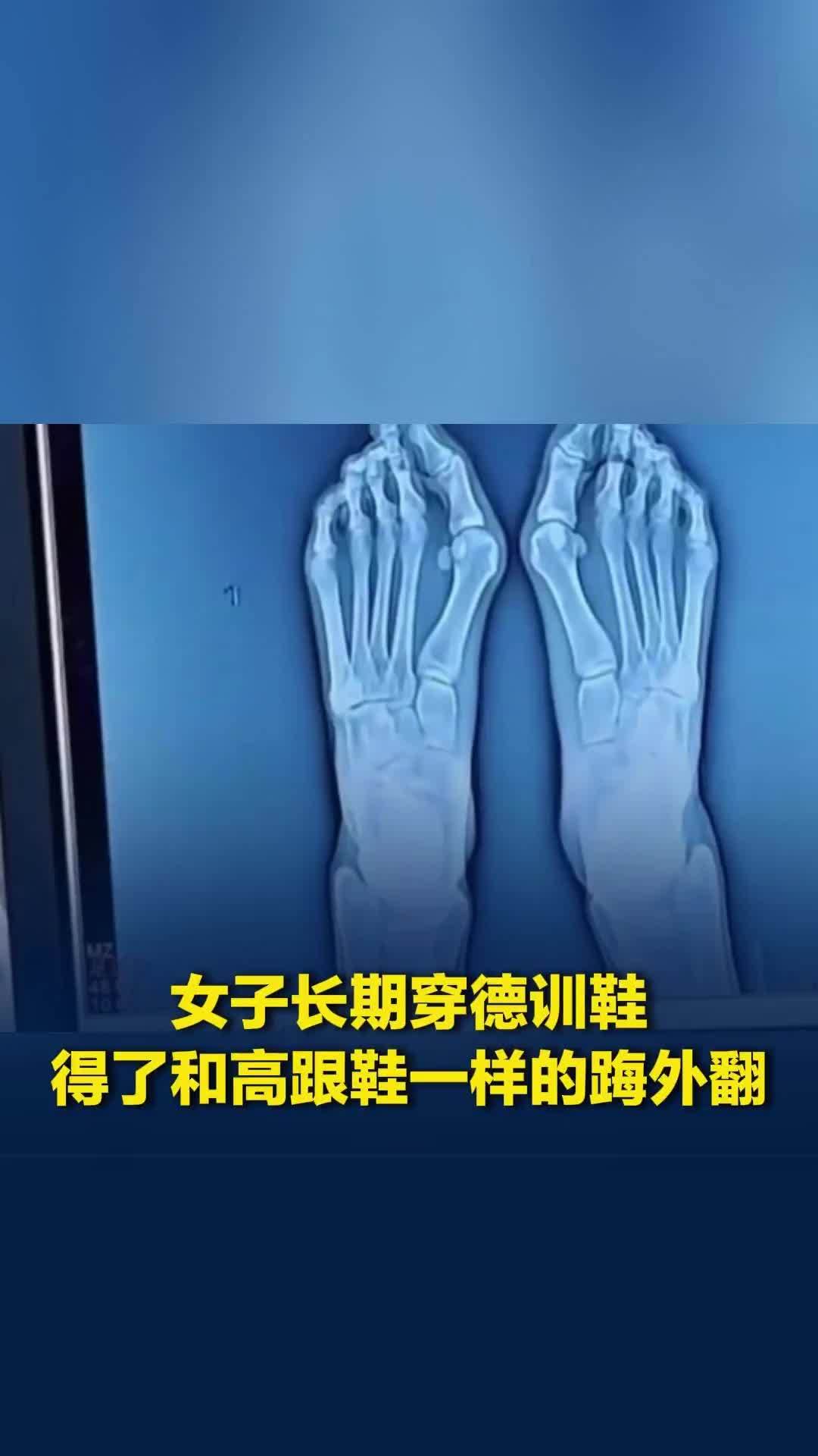 女子长期穿德训鞋，得了和高跟鞋一样的踇外翻