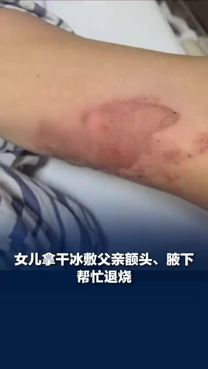 女儿拿干冰敷父亲额头腋下退烧