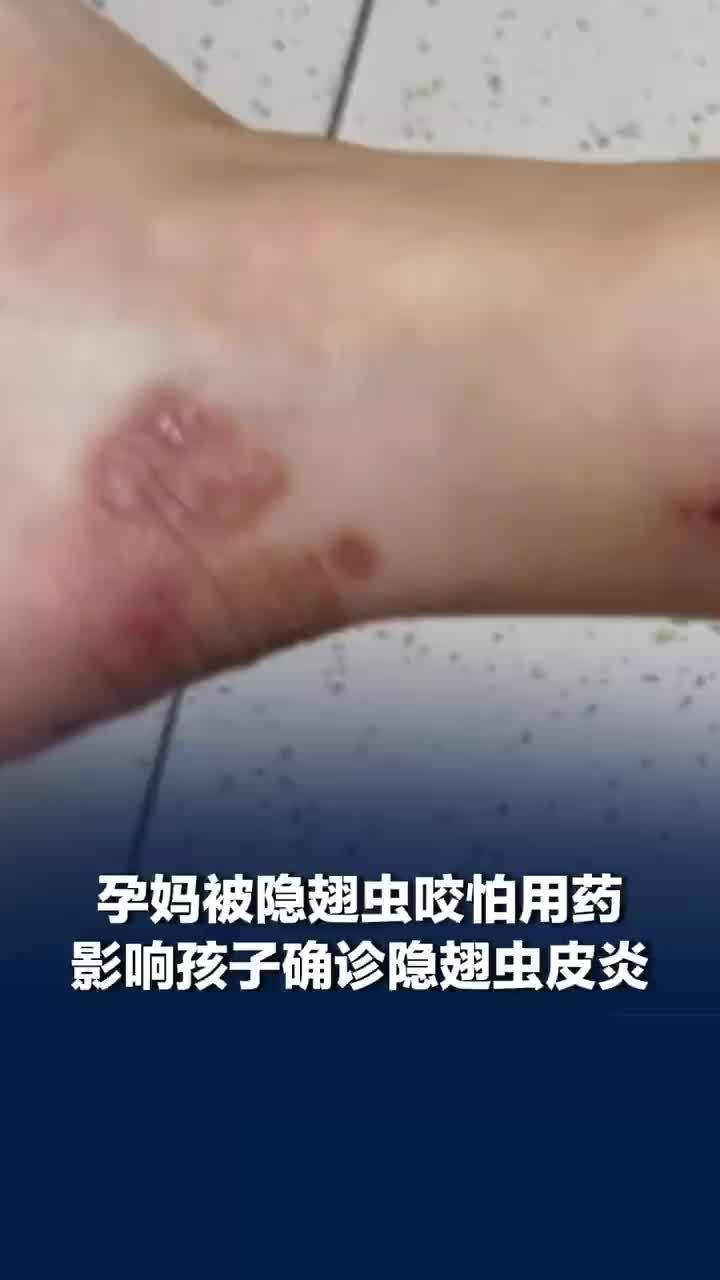 孕妈被隐翅虫咬怕用药影响孩子，确诊隐翅虫皮炎