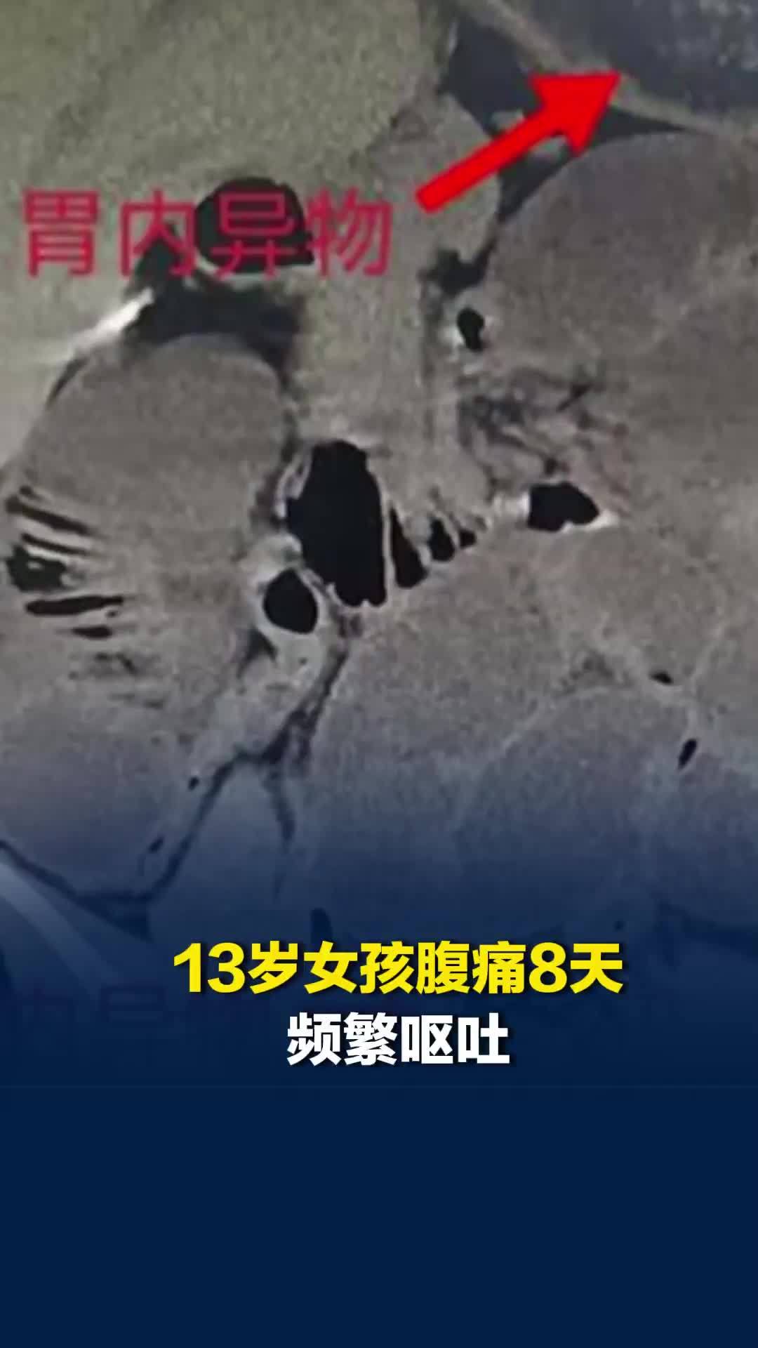 13岁女孩腹痛8天频繁呕吐，医生：异食症，手术取出6盆头发