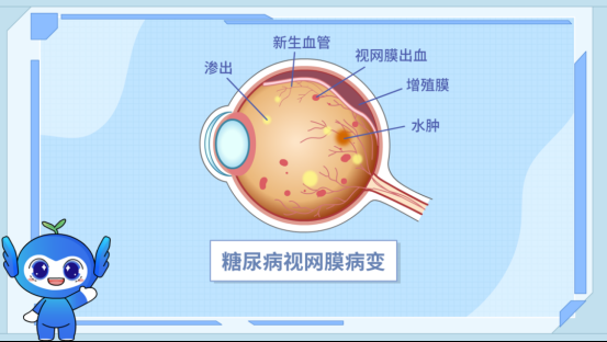 攻克6期重度糖网难题,大理爱尔眼科尹志成主任为丽江眼底病患者重塑光明