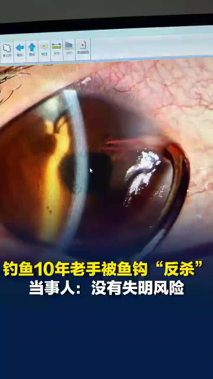钓鱼老手拽鱼鱼线回弹鱼钩刺入眼睛