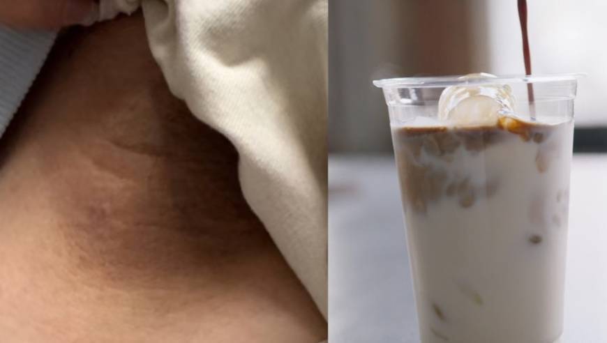 每天一杯奶茶，17岁女生脖子越来越黑，医生：是这里在报警