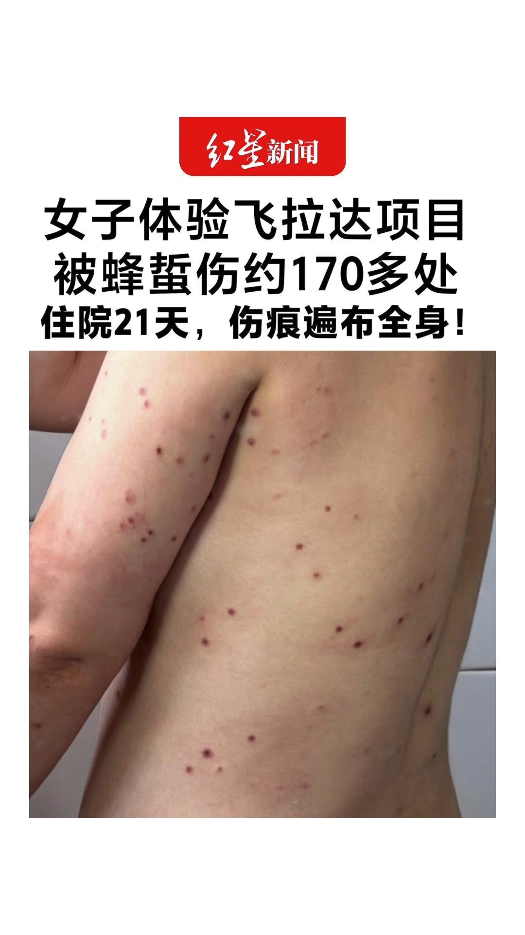 女子体验飞拉达项目 全身被蜂蜇伤约170多处！住院21天，向商家索赔5万 当地政府已介入调解
