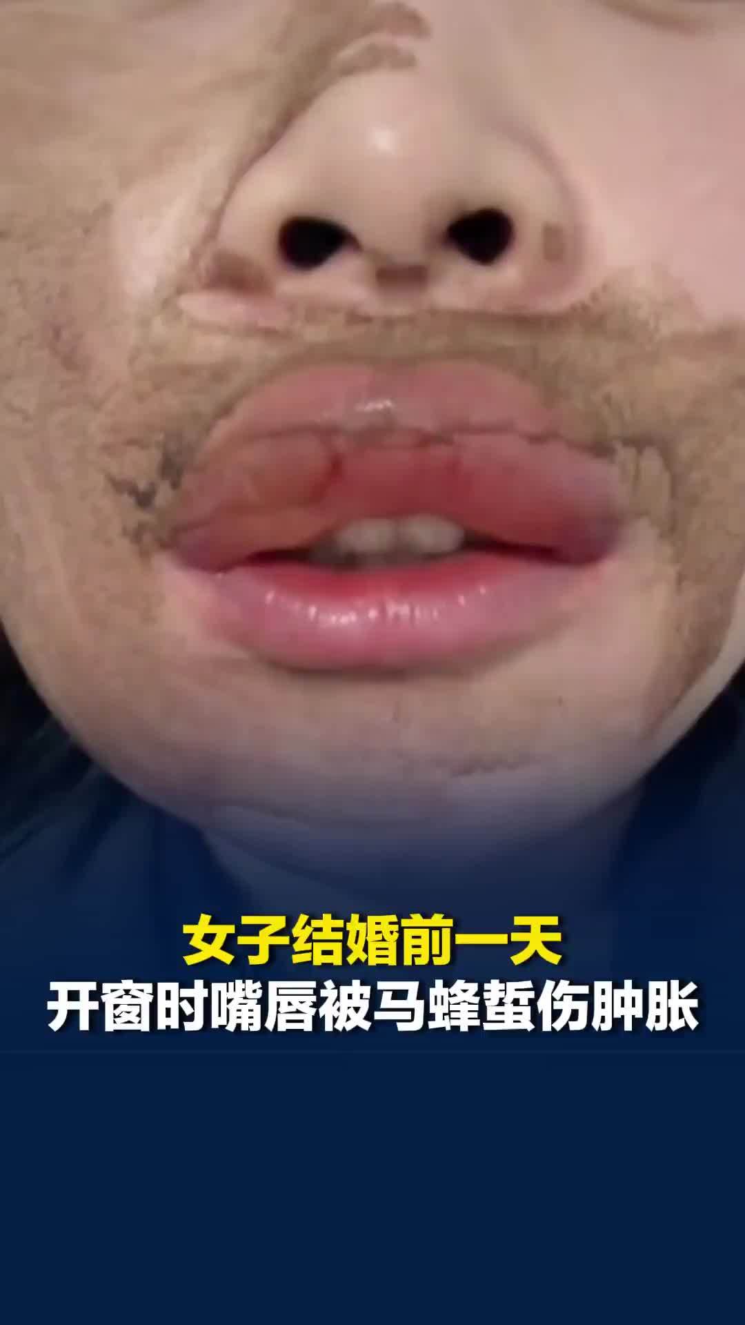 四川一女子结婚前一天开窗时嘴唇被马蜂蜇伤肿胀，当事人：打了点滴消肿了一些