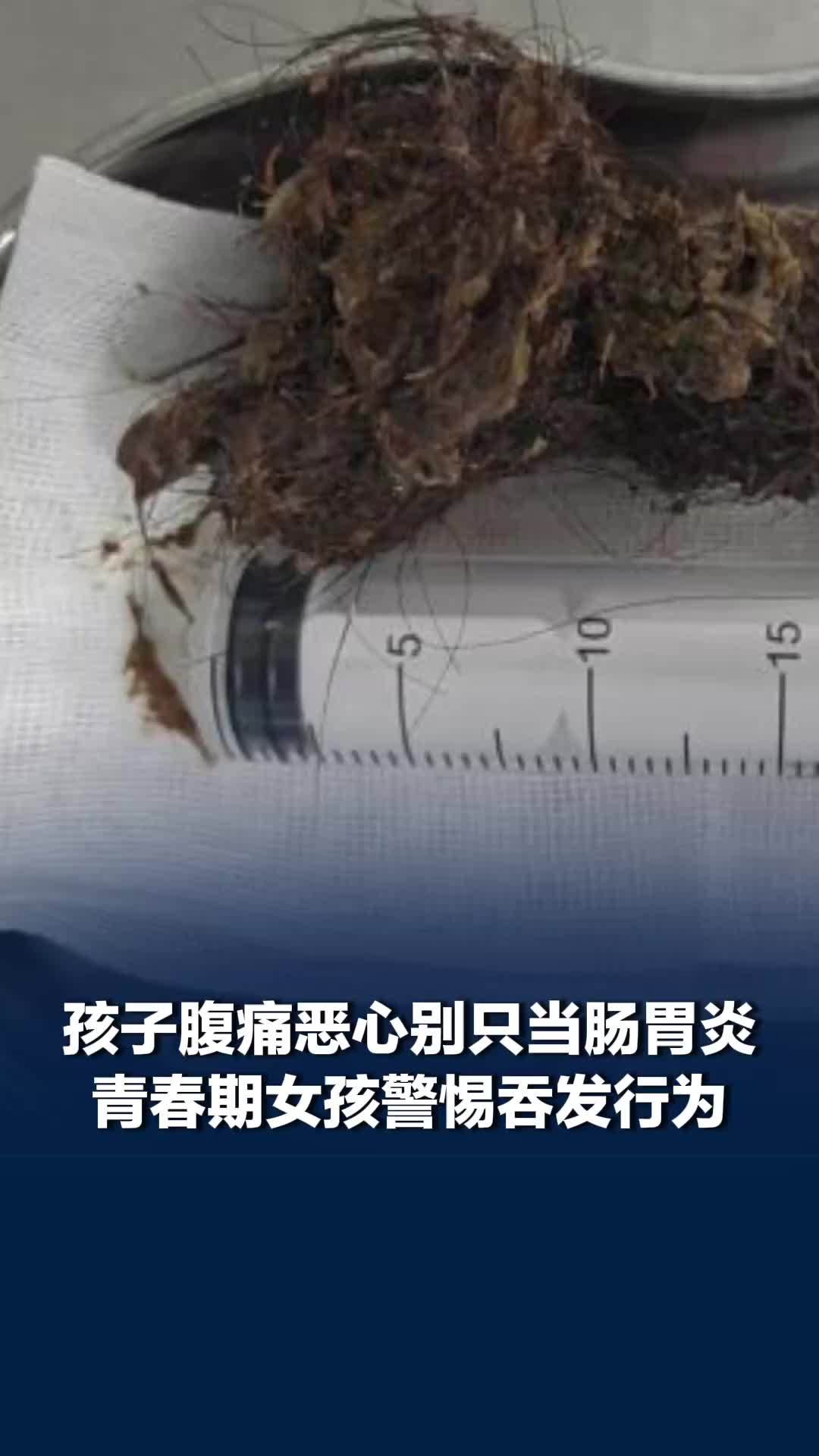 孩子反复腹痛恶心，别只当肠胃炎！12岁女孩胃里取出二三十厘米毛发团