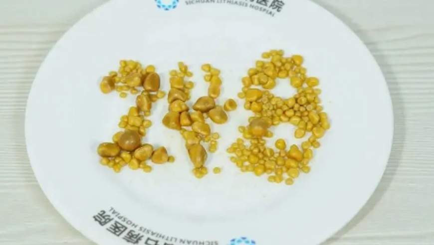 26岁男子体内取出248枚“金豆”！平常特别爱吃这些，医生郑重提醒