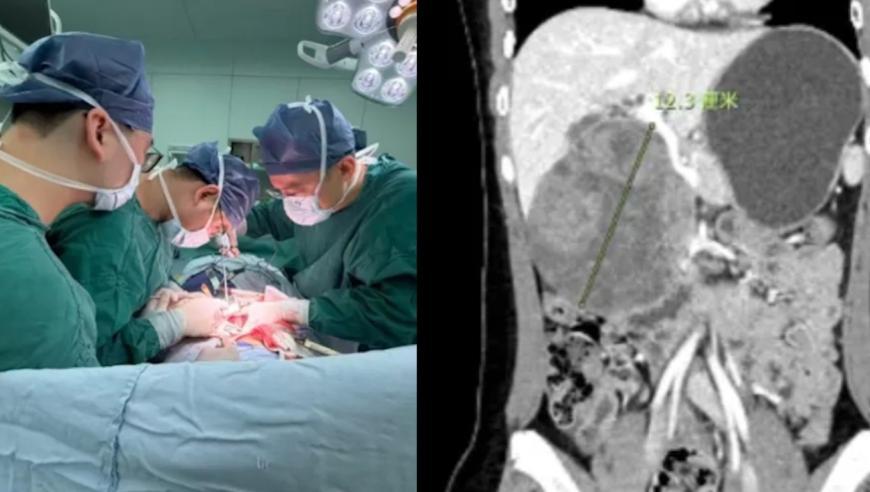 13岁女孩腹中藏12cm“手榴弹”，最终确诊偏爱年轻女性的少见病！医生提醒