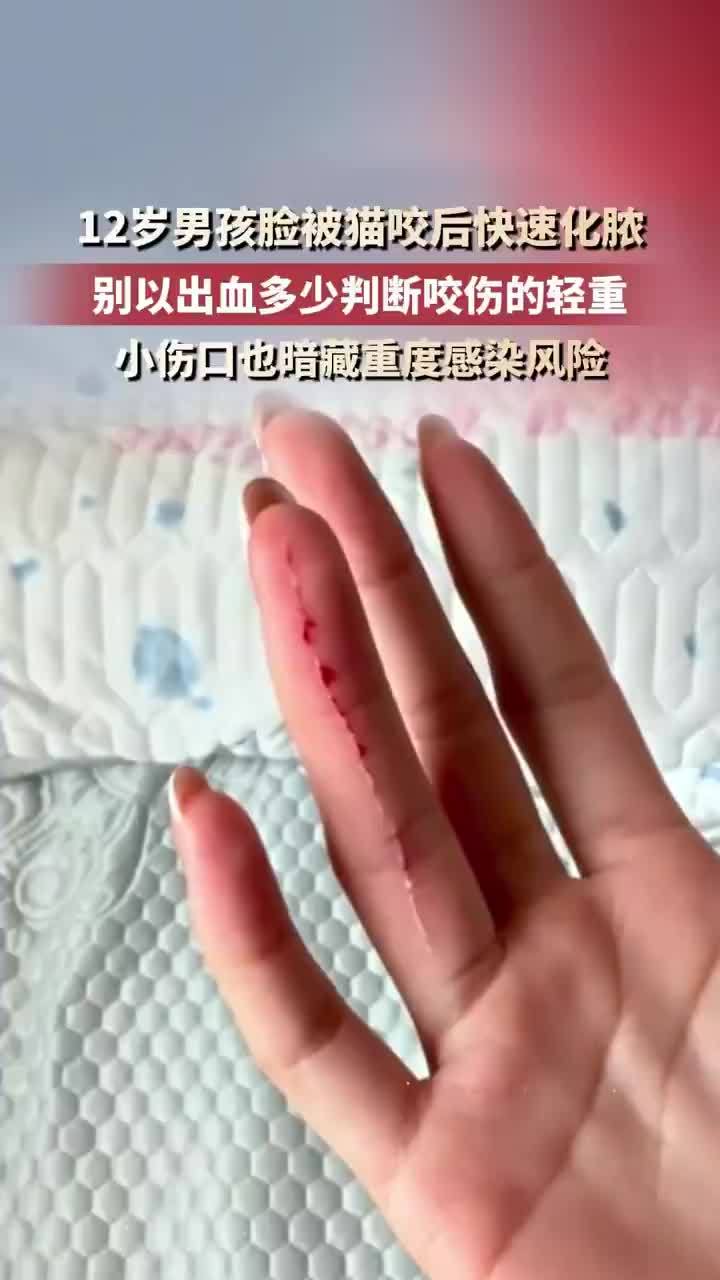 12岁男孩脸被猫咬后快速化脓
