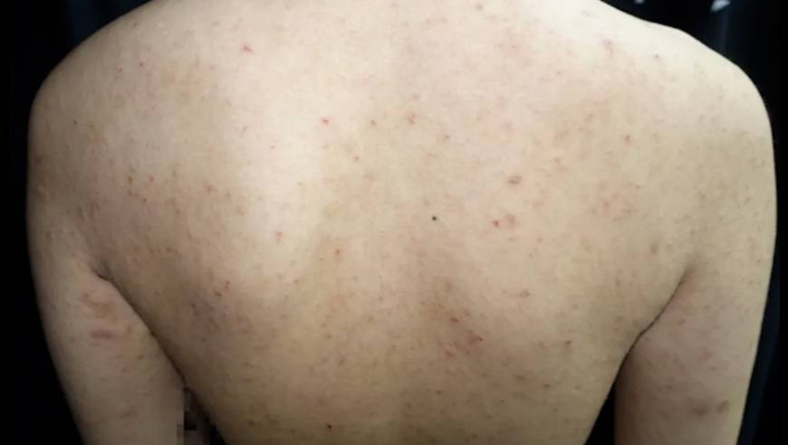 传染性极强！27岁女子旅游后浑身瘙痒、起红疹，拖了一年也没治好