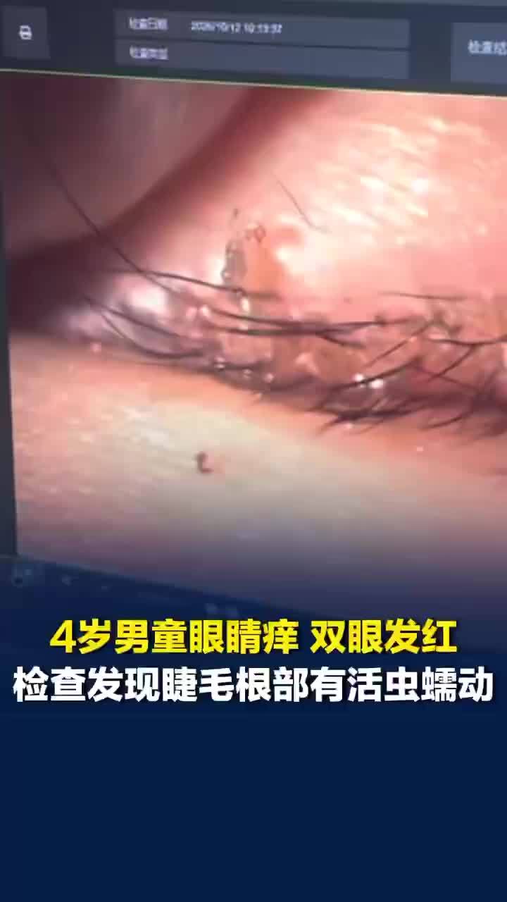 男童双眼发红查出睫毛根部有活虫