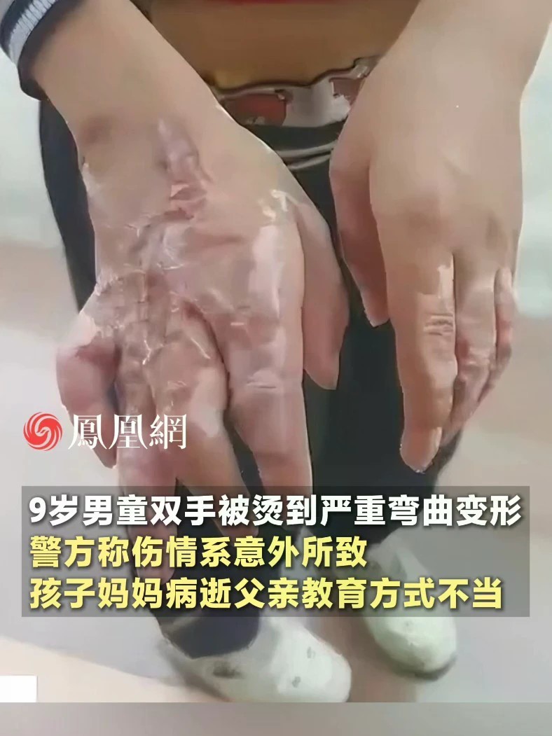 9岁男童双手被烫到严重弯曲变形，警方称走访调查后确认伤情系意外所致，孩子妈妈病逝父亲有时教育方式不当#四川#南充#社会