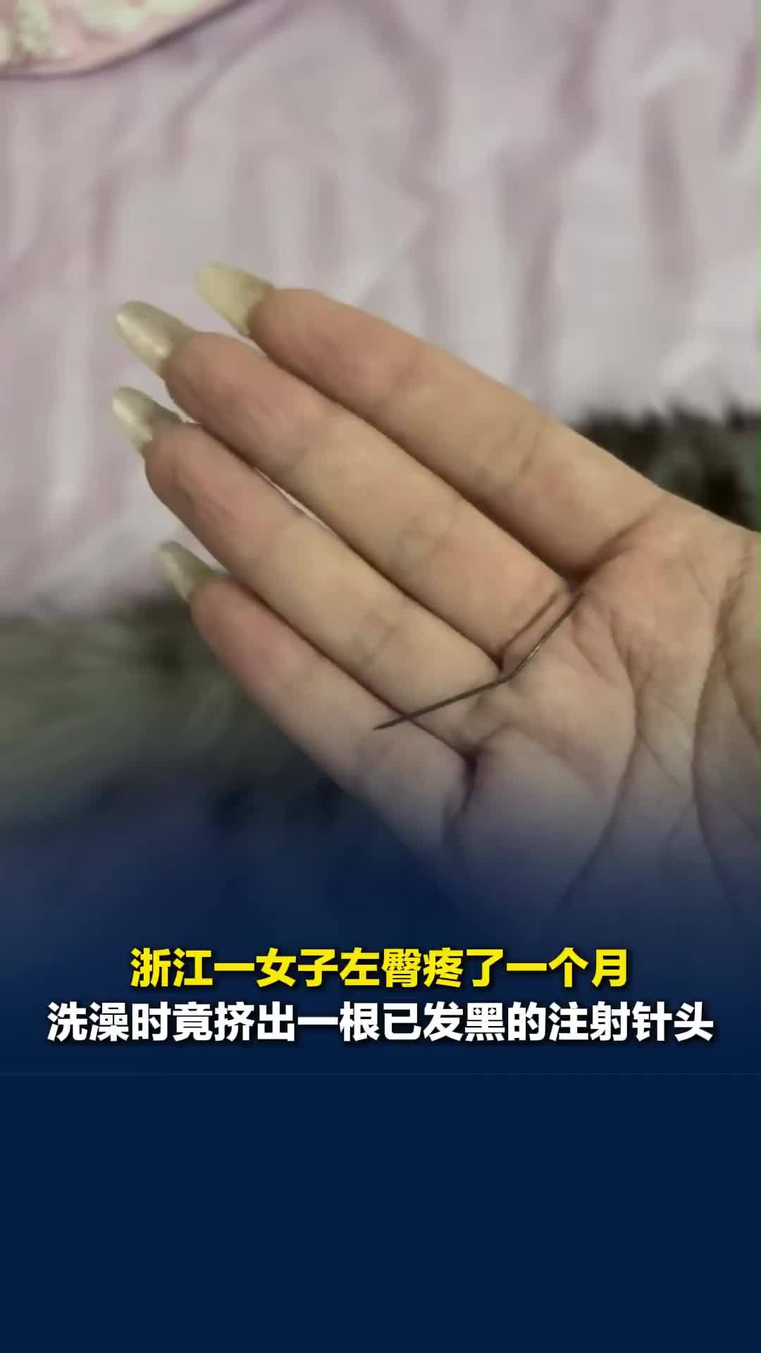 浙江一女子左臀疼了一个月，洗澡时竟挤出一根已发黑的注射针头