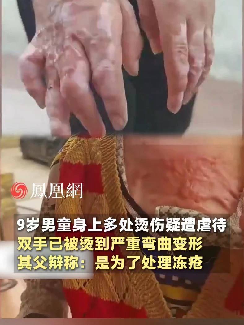 9岁男童身上多处烫伤疑遭虐待，双手已被烫到严重弯曲变形，其父辩称：是为了处理冻疮#四川 #南充 #社会