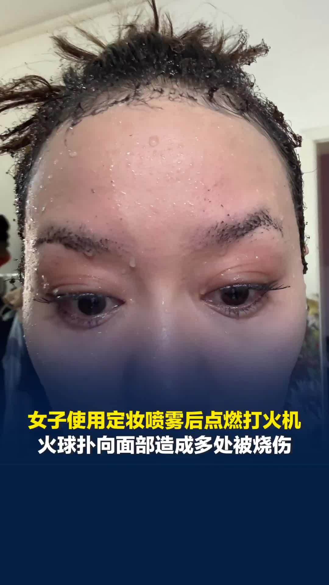 女子使用定妆喷雾后点燃打火机，火球扑向面部造成多处被烧伤，眉毛几乎被烧光