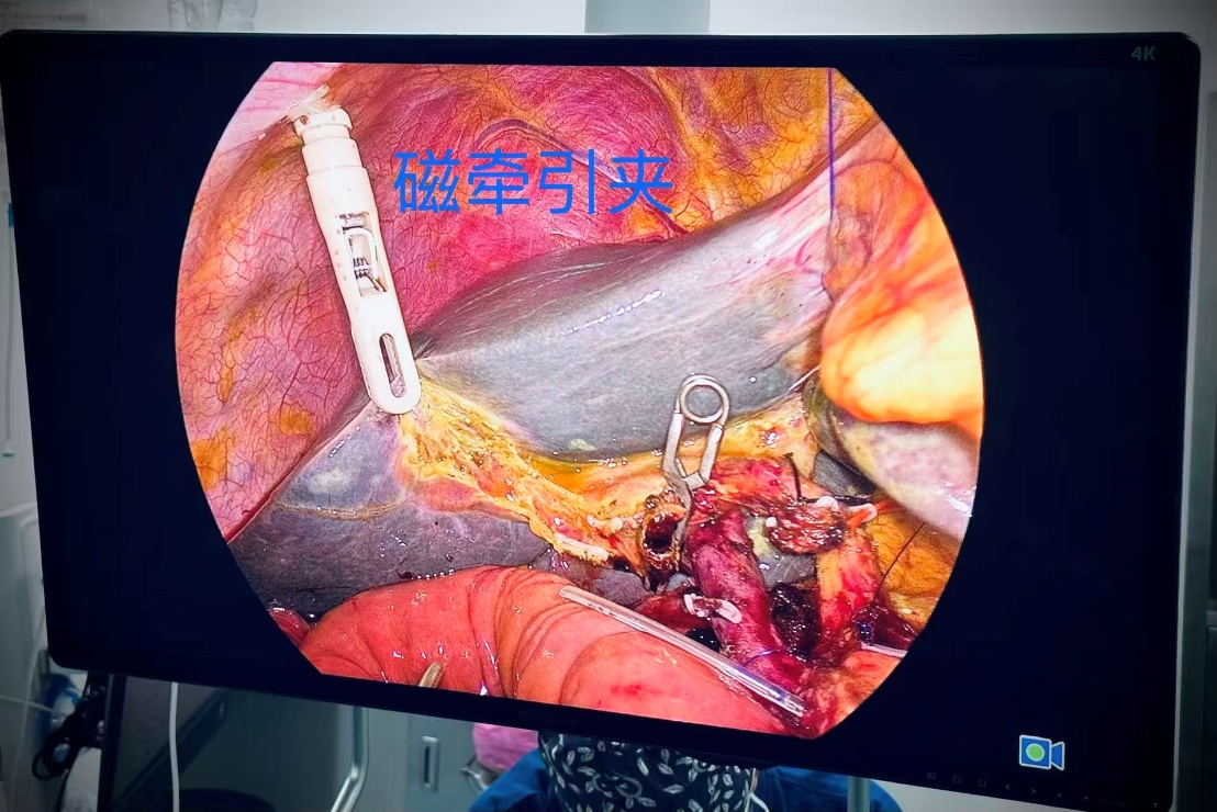 单孔腹腔镜三脏器手术术中模式