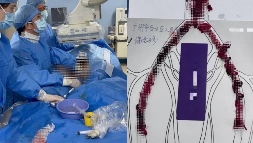 25岁小伙从肚子到腿血管全堵死，手术取出大量血栓触目惊心，医生：4个习惯把他害惨
