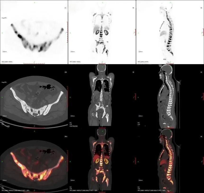 患者治疗前PSMA-PET/CT提示广泛骨转移及多发淋巴结转移