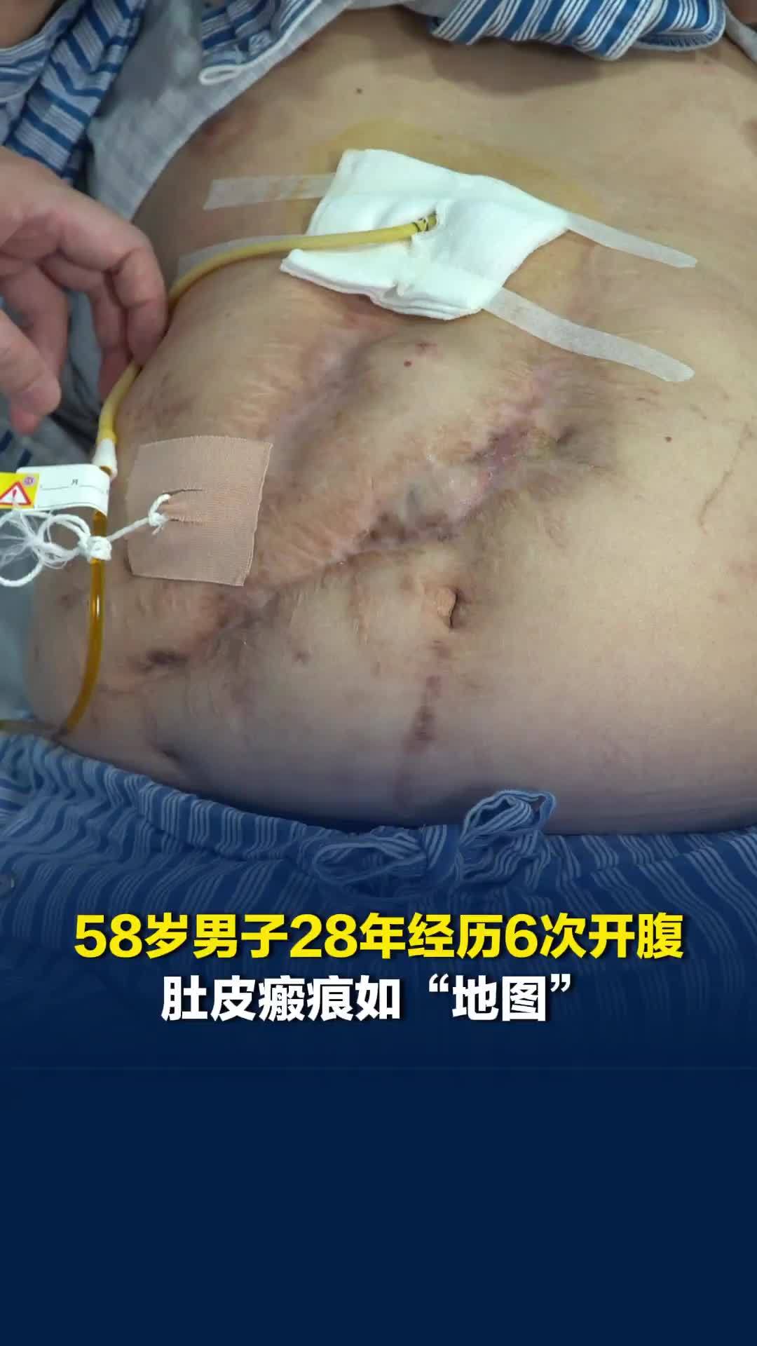 58岁男子被肝胆管结石困扰28年！经6次开腹肚皮瘢痕如“地图”，微创手术破解顽疾