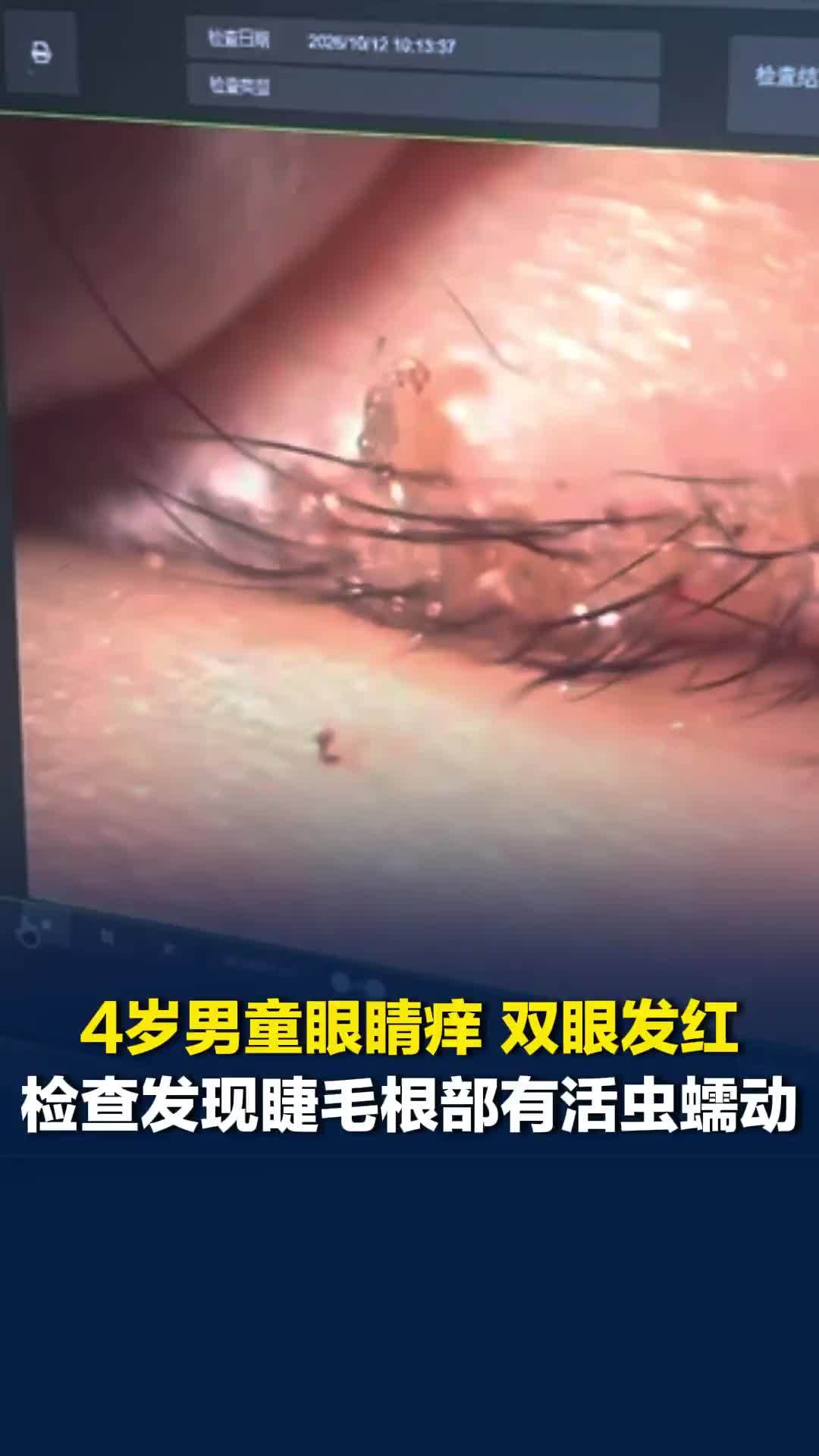 4岁男童眼痒双眼发红，检查发现睫毛根部有活虫蠕动，医生：不共用毛巾、衣物或脸盆