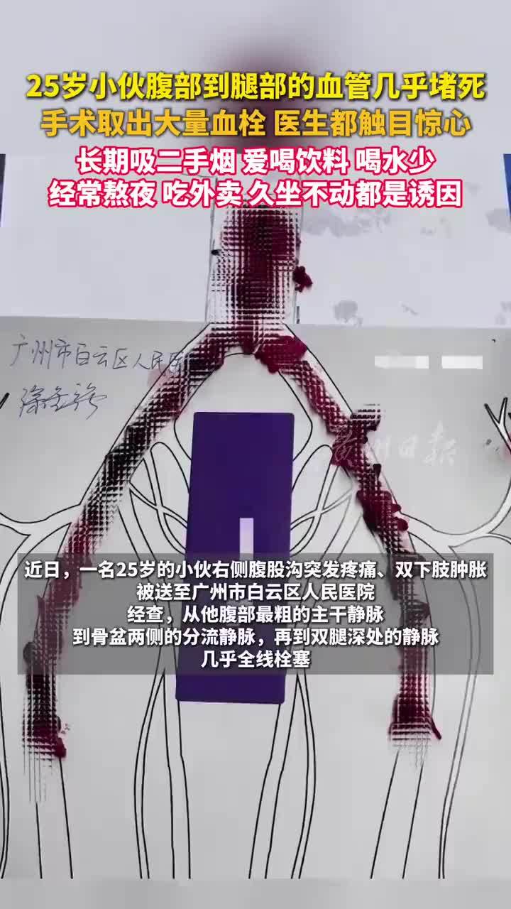 25岁小伙腹部到腿部的血管几乎堵死