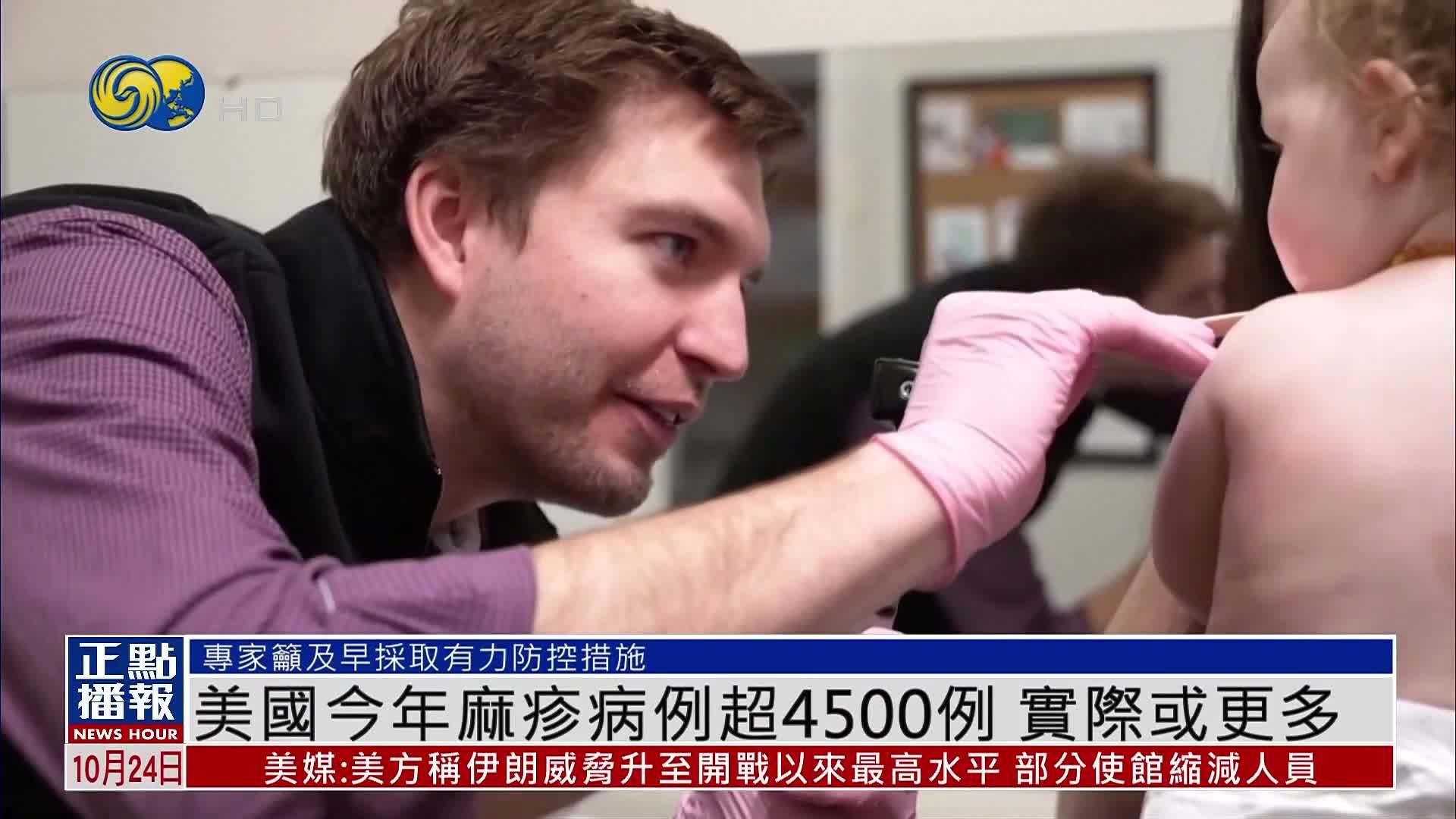 美国今年麻疹病例超4500例 实际或更多