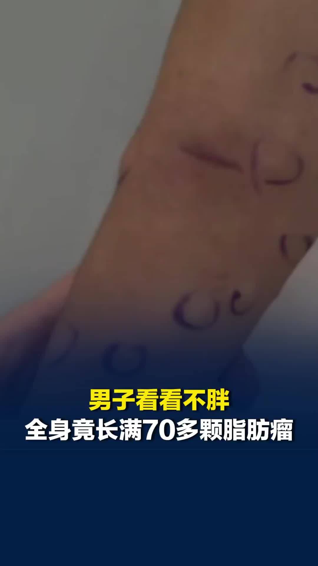 男子看看不胖，全身竟长满70多颗脂肪瘤，立即做了手术