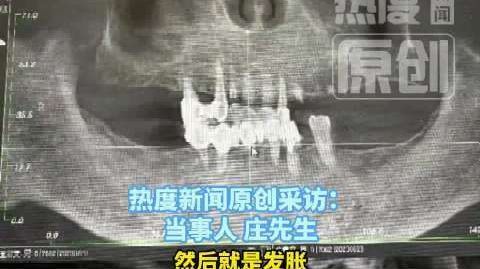 【76岁老人一次性被拔13颗牙种12颗】老人被拔13颗牙种12颗后重