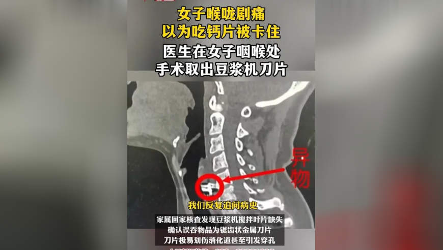 女子喉咙痛以为吃钙片卡住 医生在女子咽喉处手术取出豆浆机刀片